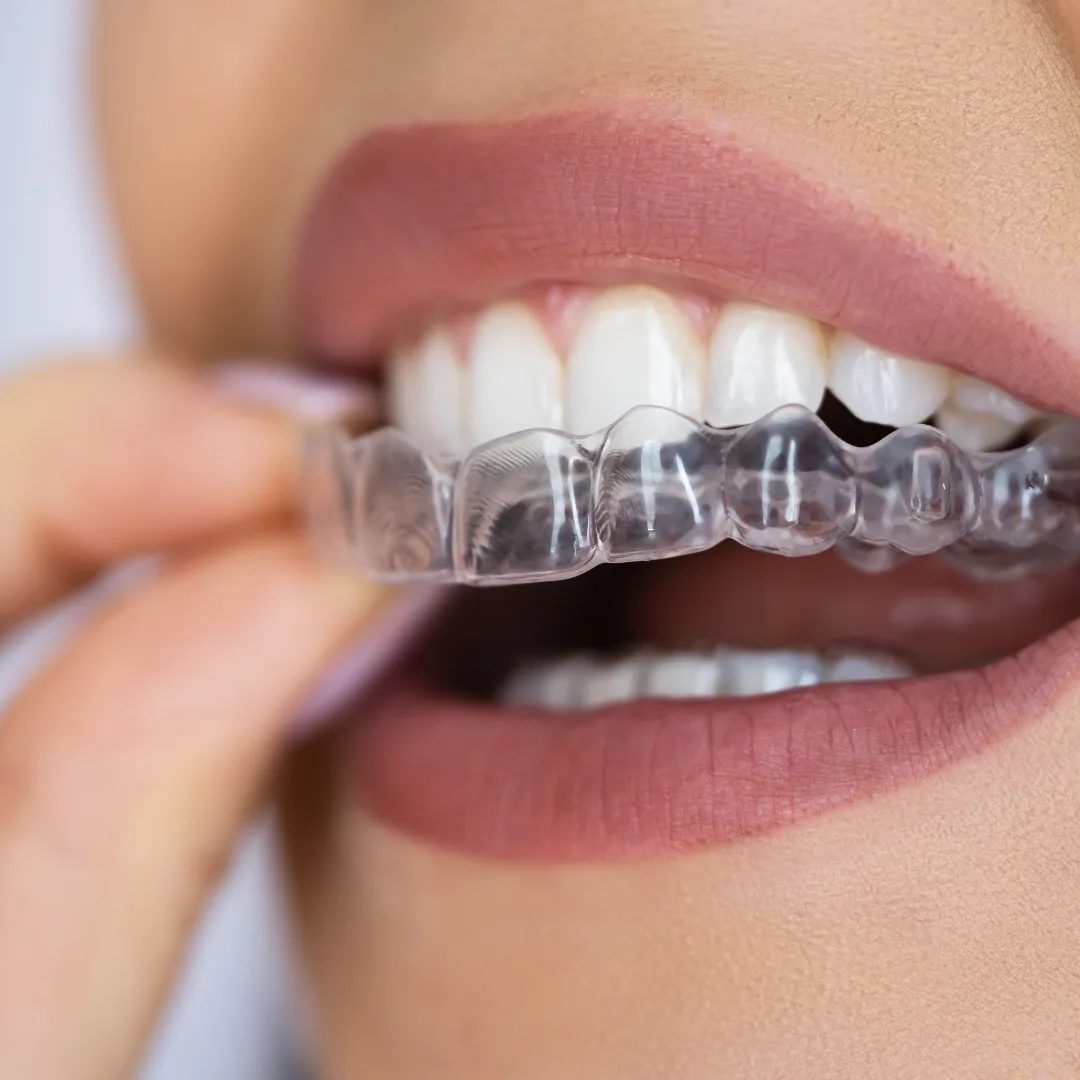 Clear aligner orthodontic treatment at Thrive Dental
