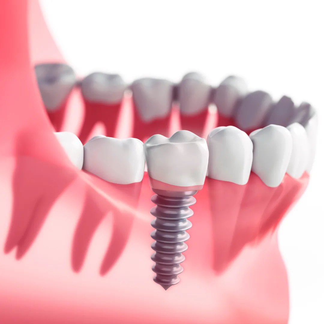 Straumann dental implant placement at Thrive Dental