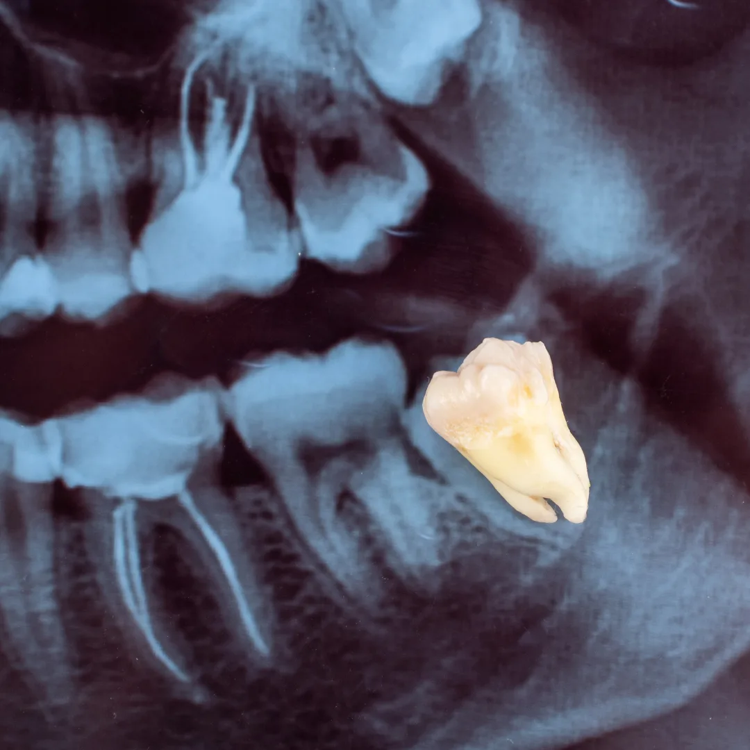 Tooth extraction procedure at Thrive Dental