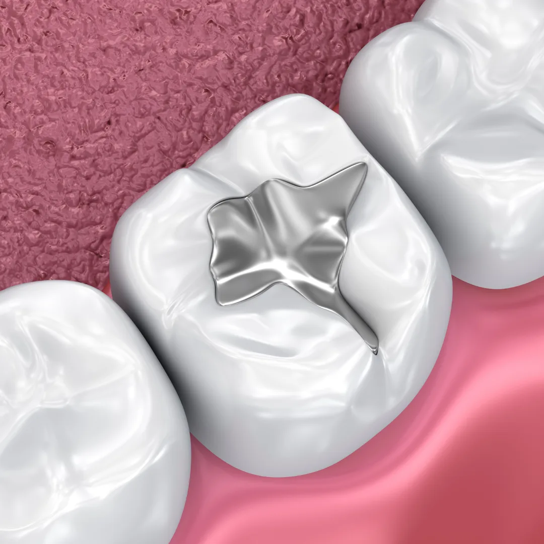 Dental filling procedure at Thrive Dental