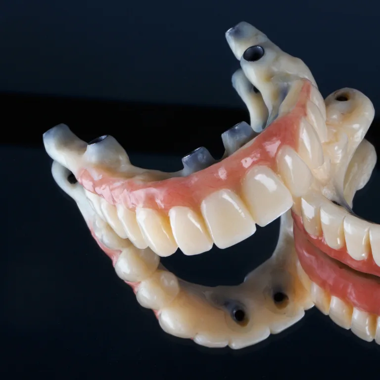 Full arch implant restoration