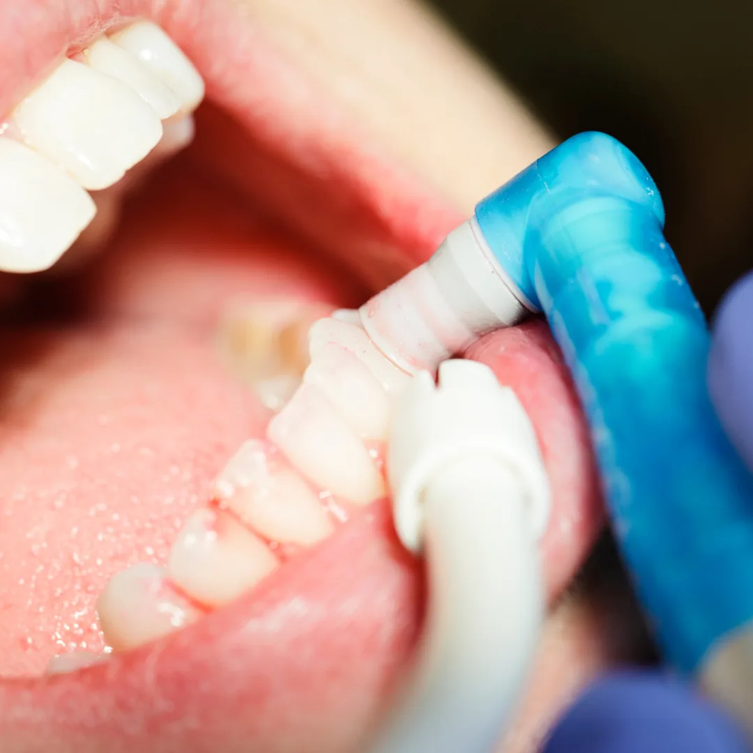 Dental hygienist performing teeth cleaning