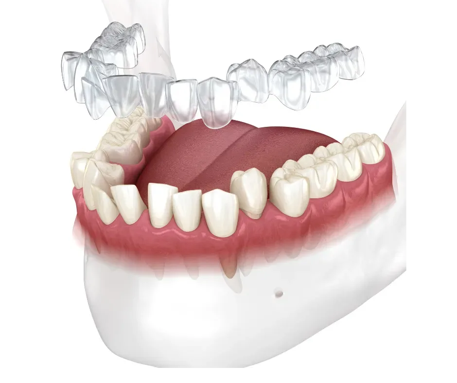 Clear aligner orthodontic treatment