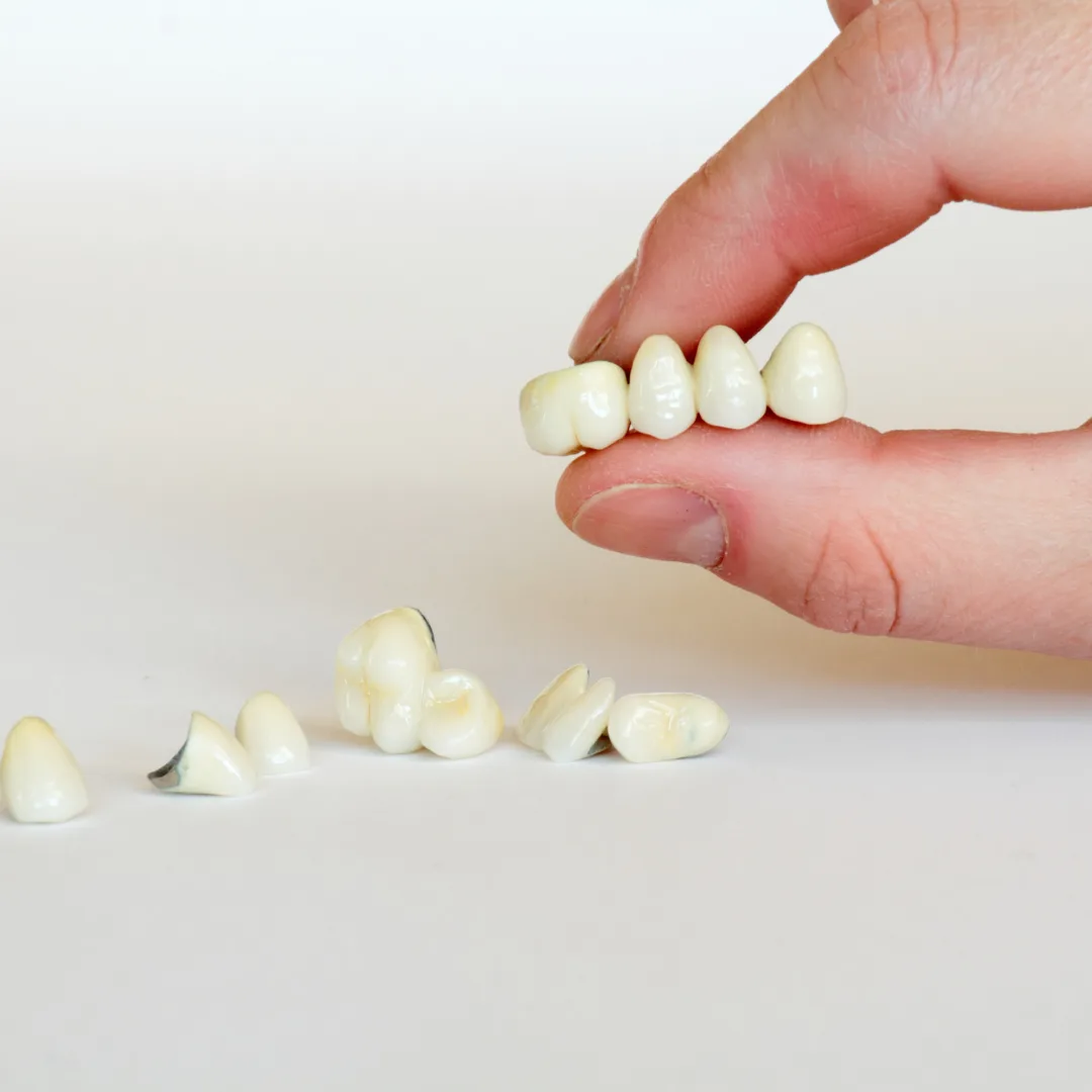 Dental bridge procedure