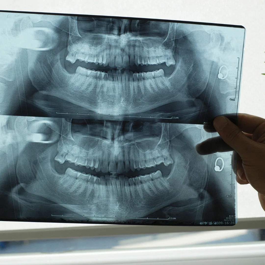 Panoramic dental X-ray
