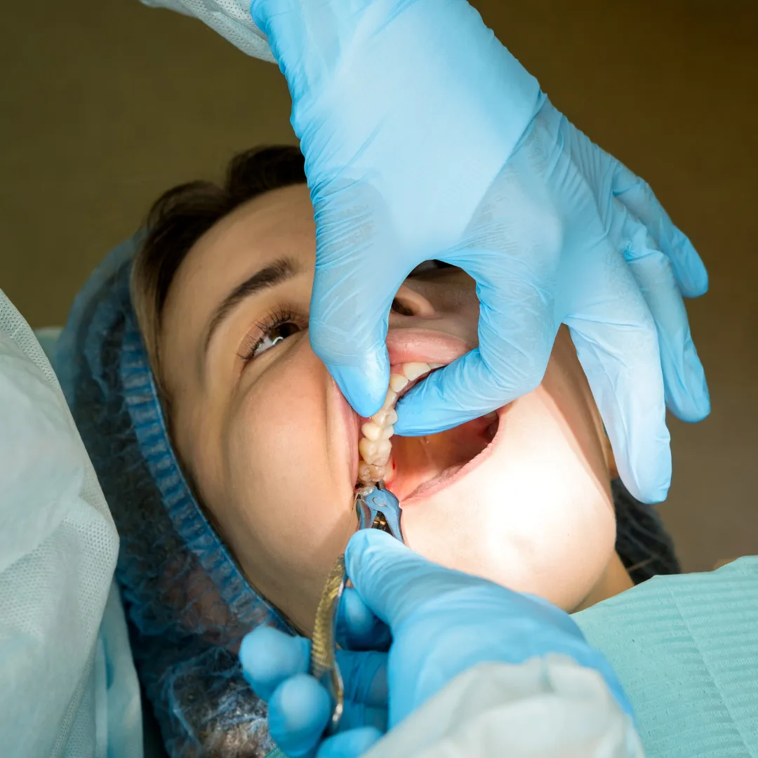 Tooth extraction procedure