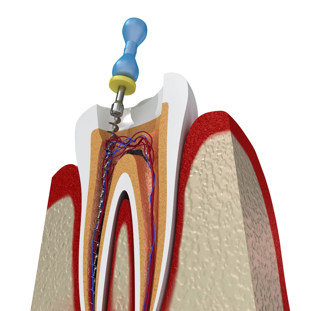 Endodontic procedure