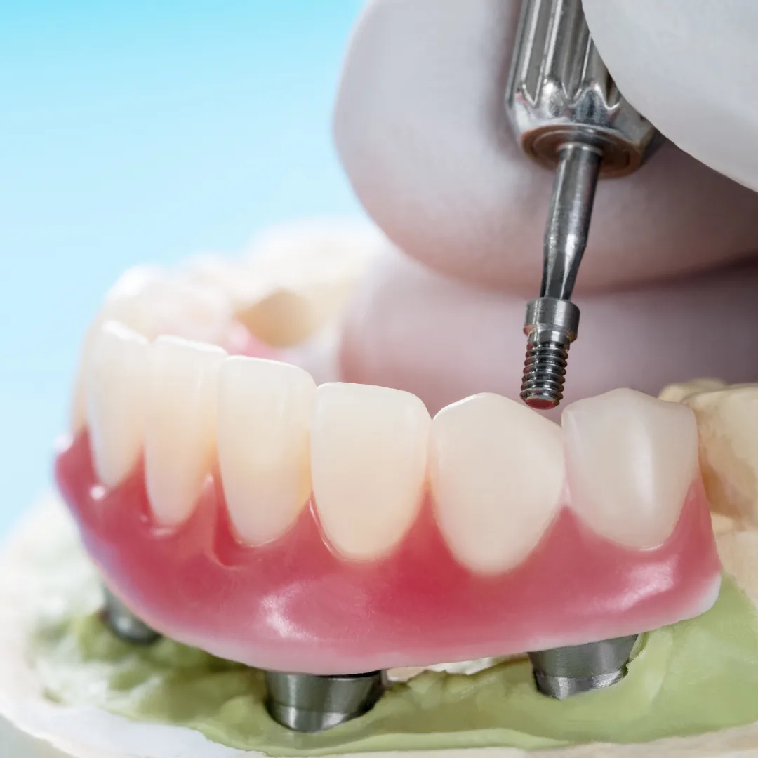 Implant-supported all-arch dental solutions at Thrive Dental